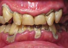 Loose or missing teeth can create problems, like making it hard for your to eat the foods you like. Are you at risk?