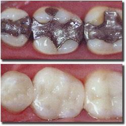 Treatment dental decay Restoration