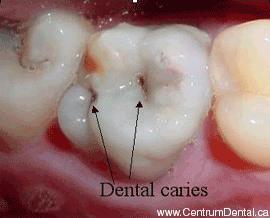 Dental decay Progression of decay takes time Could be difficult to detect by the naked eye during the early stages (even by dentists) Early disease=unspecific symptoms, no signs
