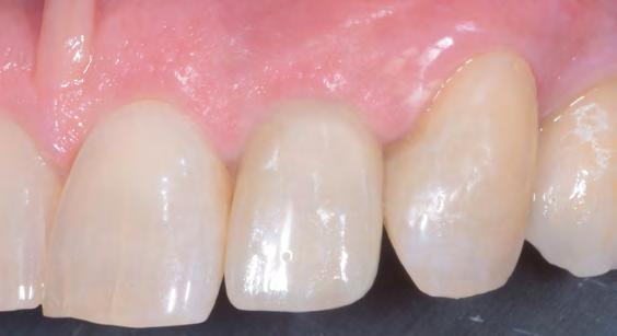 An esthetic improvement can be noted when compared with the baseline image. The free gingival margin has been shifted in a coronal direction.