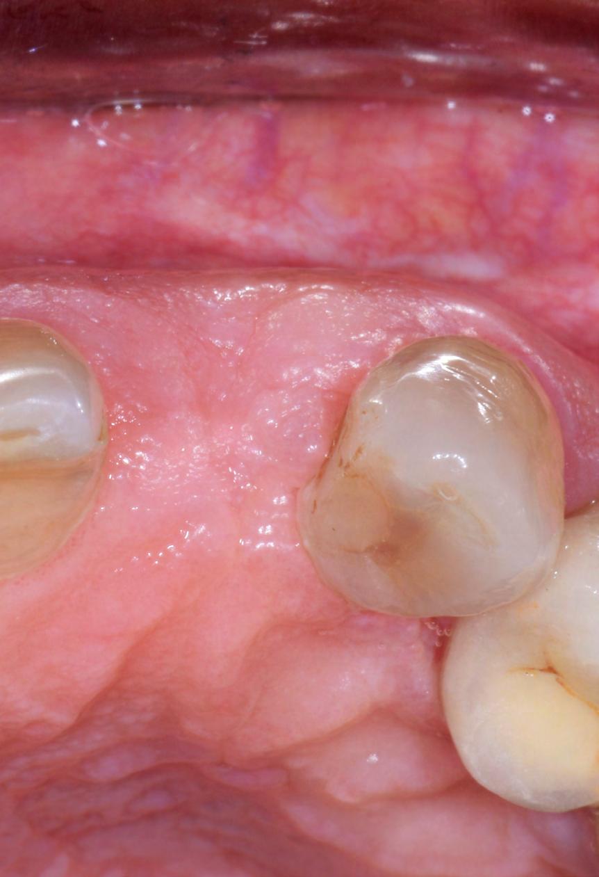 implant placement can be planned 4 months after the ridge augmentation procedure.