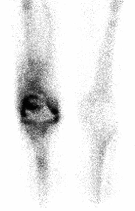 ANKYLOSIS DUE TO HETEROTOPIC OSSIFICATION 505 Fig. 3. Two year postoperative radiograph showing the Finn rotating hinge in good position without heterotopic ossification. Fig. 2.