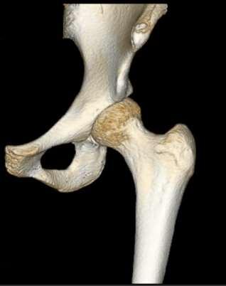 acetabular/labral iliopsoas tendon C-sign lateral acetabular/labral