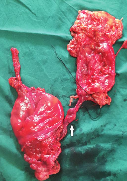 Three patients who had concomitant bladder tumors were initially staged with Trans urethral resection of bladder tumor.