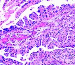 The nonmicropapillary component in both cases consisted of highgrade invasive urothelial carcinoma with extensive areas of necrosis with infiltration to subepithelial tissue in case 3 and