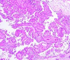 Perez-Montiel et al / MICROPAPILLARY UROTHELIAL CARCINOMA micropapillary pattern that is necessary to make this diagnosis has not been specified.