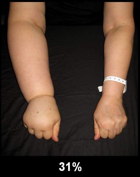 Pre- and post-operative Perometer Lymphedema defined as a