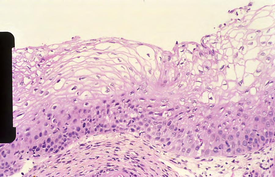Mild dysplasia (CIN1) and HPV effect in cervical biopsy.