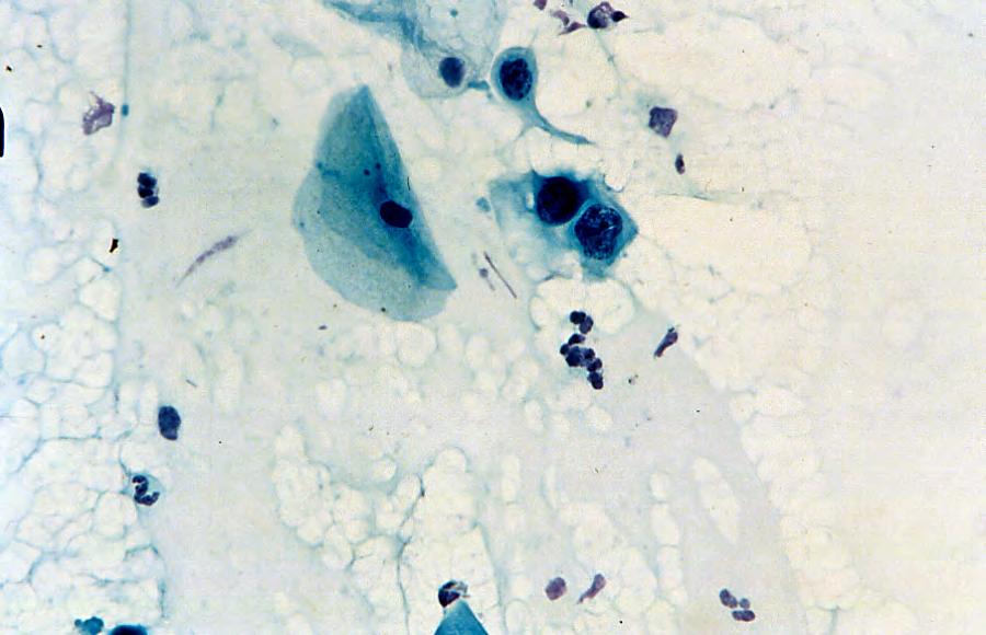 Squamous cells showing features of high grade squamous intraepithelial lesion (HSIL) (black arrows) in cervical smear.