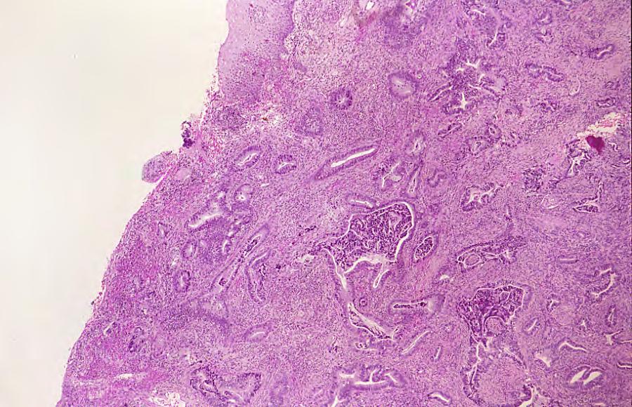 A B A. Low power view of invasive adenocarcinoma of the cervix.