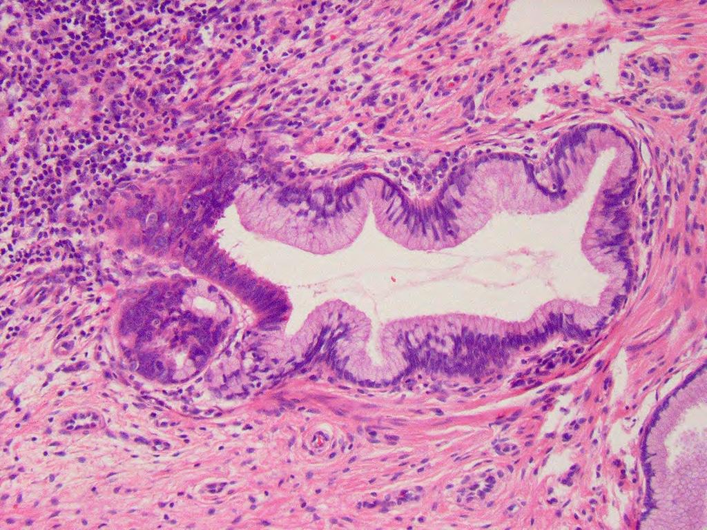 Medium power view of a focus of adenocarcinoma in situ (black star) adjacent to normal