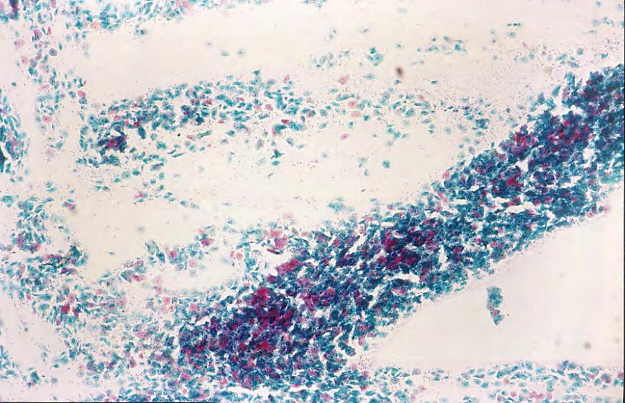 Low power view of a small portion of a cervical smear. Note the thousands of blue and pink squamous cells that need to be screened.