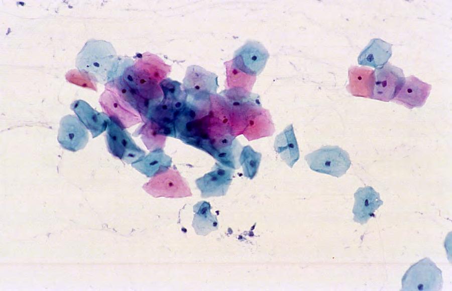 Papanicolou stain of cervical smear (high power).