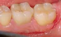 condition. She achieved her result in just one visit! K ristin wanted to whiten and lengthen her teeth.