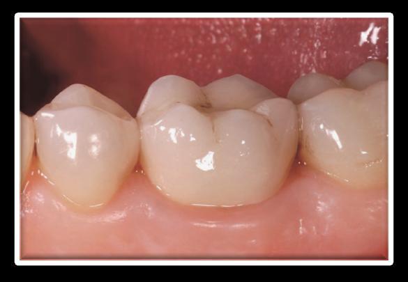 CEREC conserves your healthy tooth tissue The direct and immediate treatment of your teeth using CEREC all-ceramic restorations allows your dentist to