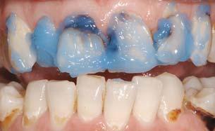 Restorations, fabricated via the CEREC process, recently have found favor for aesthetic anterior indications as a result of their improved fit, porcelain milling, and efficient staining and glazing