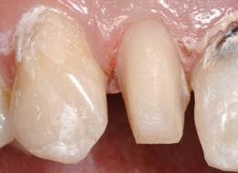 Rampant tooth decay is associated with many different factors. Every clinician should be conscious of clinical signs of drug abuse and its manifestation of associated tooth degradation.