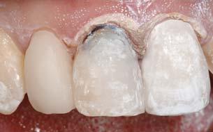 determination of incisal edge position for proper phonetics and aesthetics.