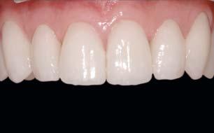 The surface glaze also provided a smooth surface that would reduce opposing tooth wear as well as seal scratches on the milled surface, which could lead to crack propagation and subsequent porcelain