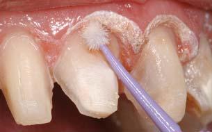 The teeth were then prepared for 30 seconds with 37% phosphoric acid, and a dentin bonding agent was applied and air thinned.