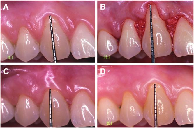 J Periodontol May 2012 Pini-Prato, Franceschi, Rotundo, Cairo, Cortellini, Nieri KT The amount of KT tended to decrease from baseline to 8 years (-0.6 0.8 mm) (Fig. 1).