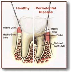 Periodontal (Gum) Disease Periodontal (gum) disease is very common. This disorder infects, inflames, and destroys the gums and bone. Unchecked periodontal disease can lead to tooth loss.