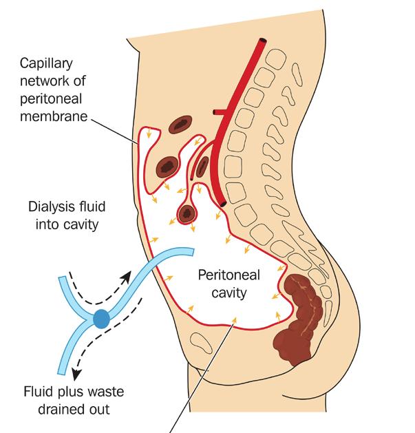 The catheter is placed by a surgeon during a minor outpatient surgery a few weeks before starting dialysis and will remain in your abdomen as long as you are on Peritoneal Dialysis.