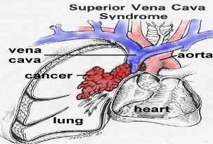 Superior Vena Cava Syndrome 1 Disseminated Intravascular Coagulation (DIC) 1 Blood flow through the superior vena cava is compressed Causes decreased venous return to the heart, decrease in cardiac