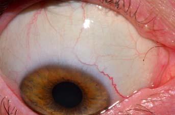 4 basic signs in the Sclera 1.