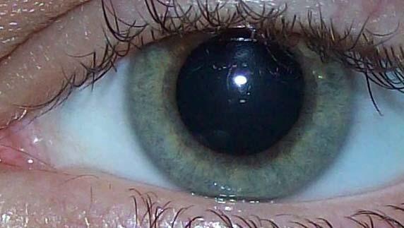 Iridology Vs Sclerology The Sclera should be white & smooth The Iris tells Genetics and the