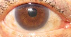 circulation and blood Liver ~ Brown Coloration Even more serious in a blue eye Brown