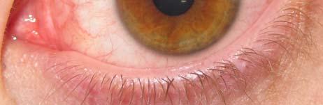 in the Sclera 1.Discoloration 2.Deposits 3.