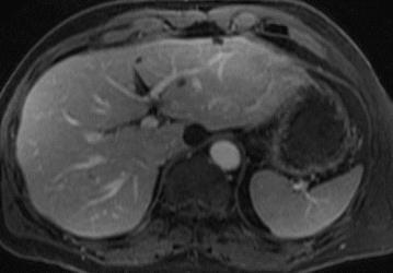 Basic Liver MRI: Suggested