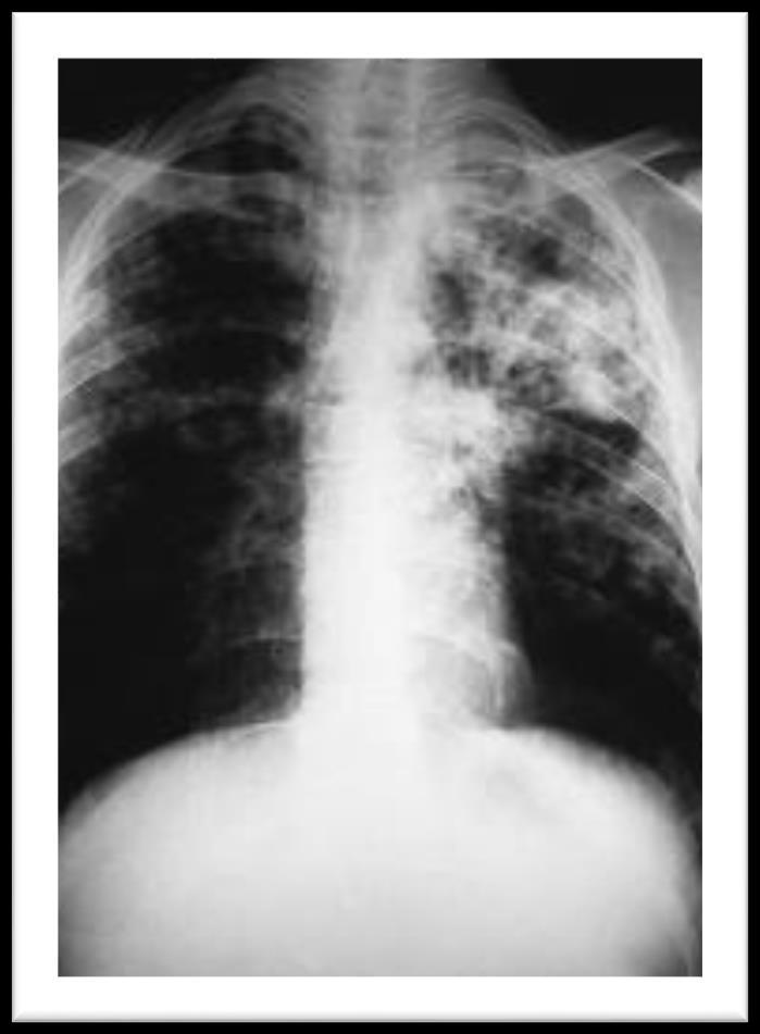 Annual TB evaluation TST conversion do CXR and send for