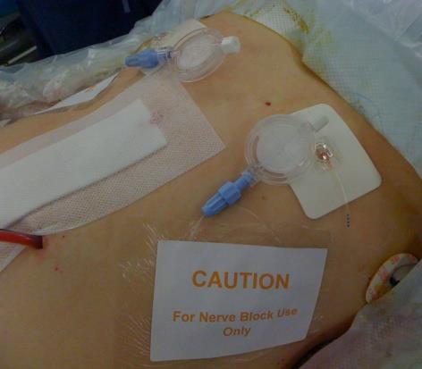 Insertion of rectus sheath catheters requires full asepsis - drapes, hat, mask, gown, sterile gloves and full size sterile cover for the ultrasound probe.