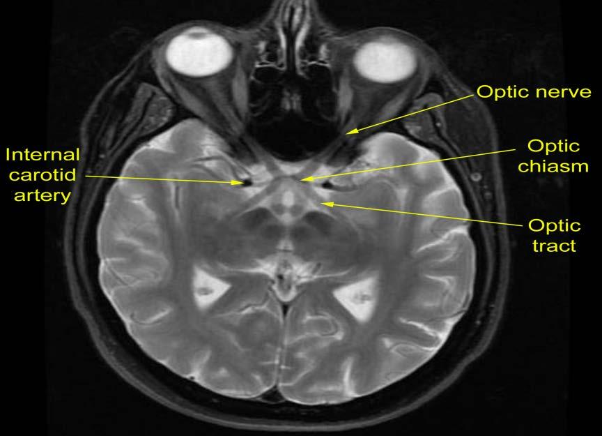 Cranial Nerve II: Optic Nerve Optic Canal