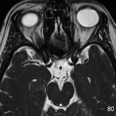 Cranial Nerve III: Oculomotor Nerve Origin: Midbrain Course: Cistern (passes between posterior cerebral artery and superior