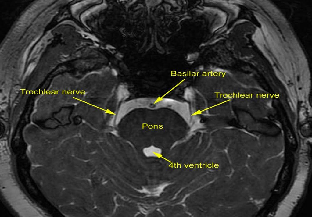 Cranial Nerve IV: Trochlear Nerve Origin: Posterior Midbrain Course: Posterior origin Travels