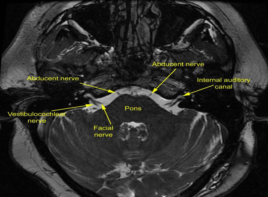 Cranial Nerve VI: Abducens Nerve Origin: pontomedullary junction Course: Cistern