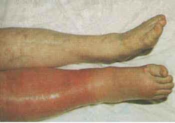 *History: complete thrombosis history, including age of onset, location, and treatment; precipitating conditions/medications; family hx; * Symptoms: swelling, pain, and erythema of the involved