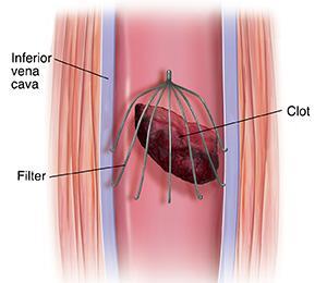 *IVC Filter in Addition to Anticoagulation for Acute DVT or PE: *In patients with acute DVT or PE who are