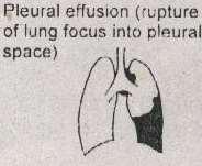 PLEURAL EFFUSION Usually Unilateral Caseating Lymphnode or