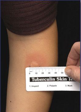 Reading the TST Measure reaction in 48 to 72 hours Measure induration, not erythema Record reaction in millimeters, not negative