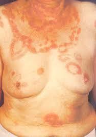 TYPES OF FUNGAL INFECTIONS Four types of infection (mycoses) are recognized: 1.