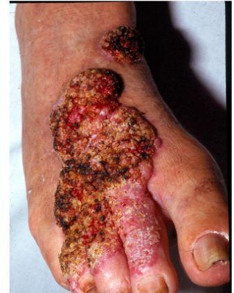 Cutaneous mycoses extend deeper into the epidermis, and also include invasive hair and nail diseases. http://www.