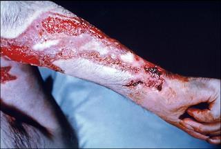 TYPES OF FUNGAL INFECTIONS 3. Subcutaneous mycoses chronic, localized infections of the skin 4.