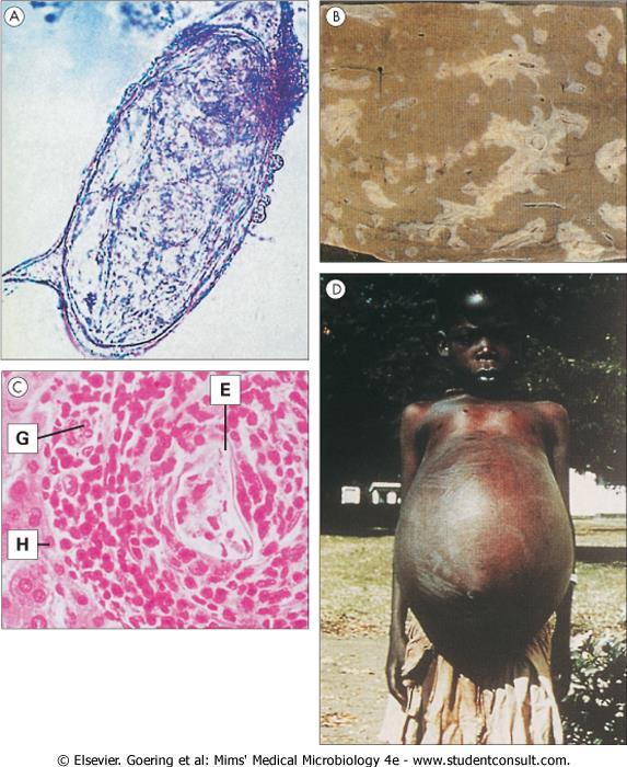 Parasitic infections affecting the liver (A) Egg of S.
