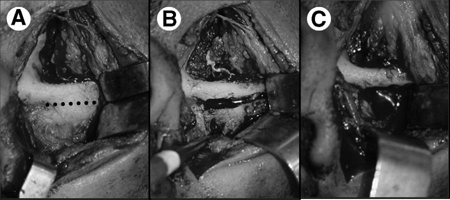 2600 CHRONIC MANDIBULAR DISLOCATION Patients and Methods A retrospective evaluation of 10 patients treated by eminectomy and 8 treated by use of miniplates with chronic mandibular dislocations was