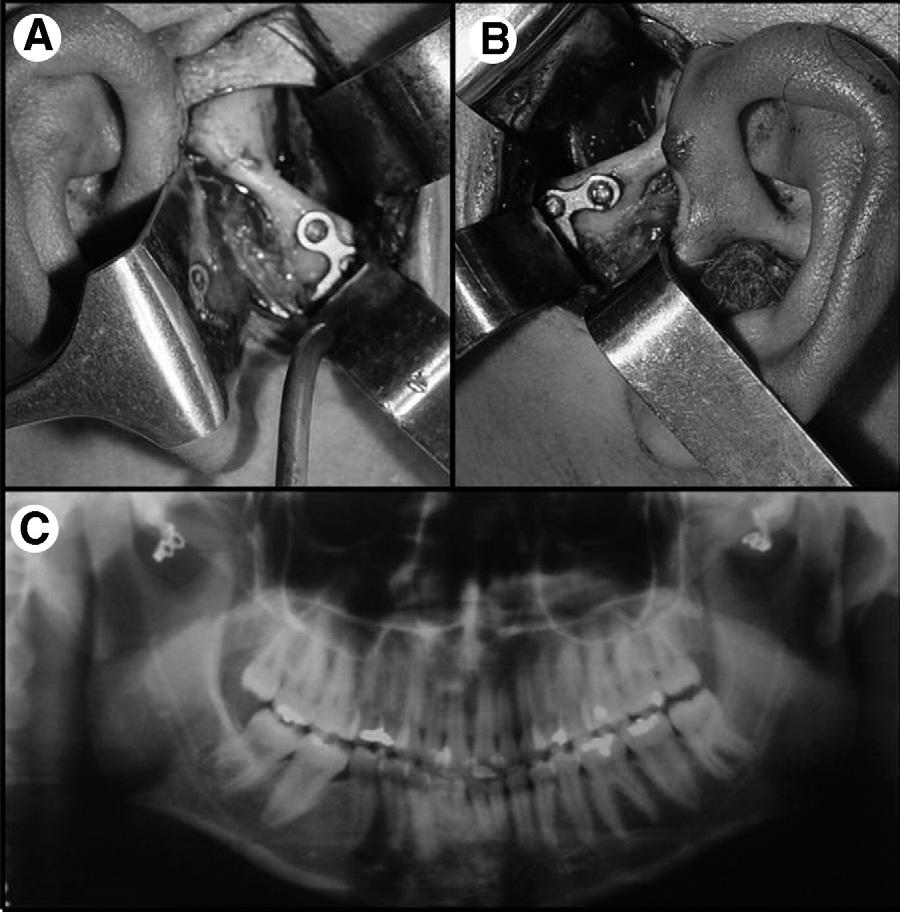 VASCONCELOS AND PORTO 2601 FIGURE 2. Surgical procedure for miniplates. A, Placement of an L-shaped 2.0-mm miniplate on right side. B, Placement of miniplate on left side.