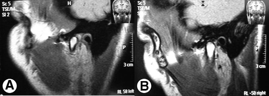 2602 CHRONIC MANDIBULAR DISLOCATION FIGURE 3. Magnetic resonance images showing placement of articular disc on left side (A) and on right side (B).